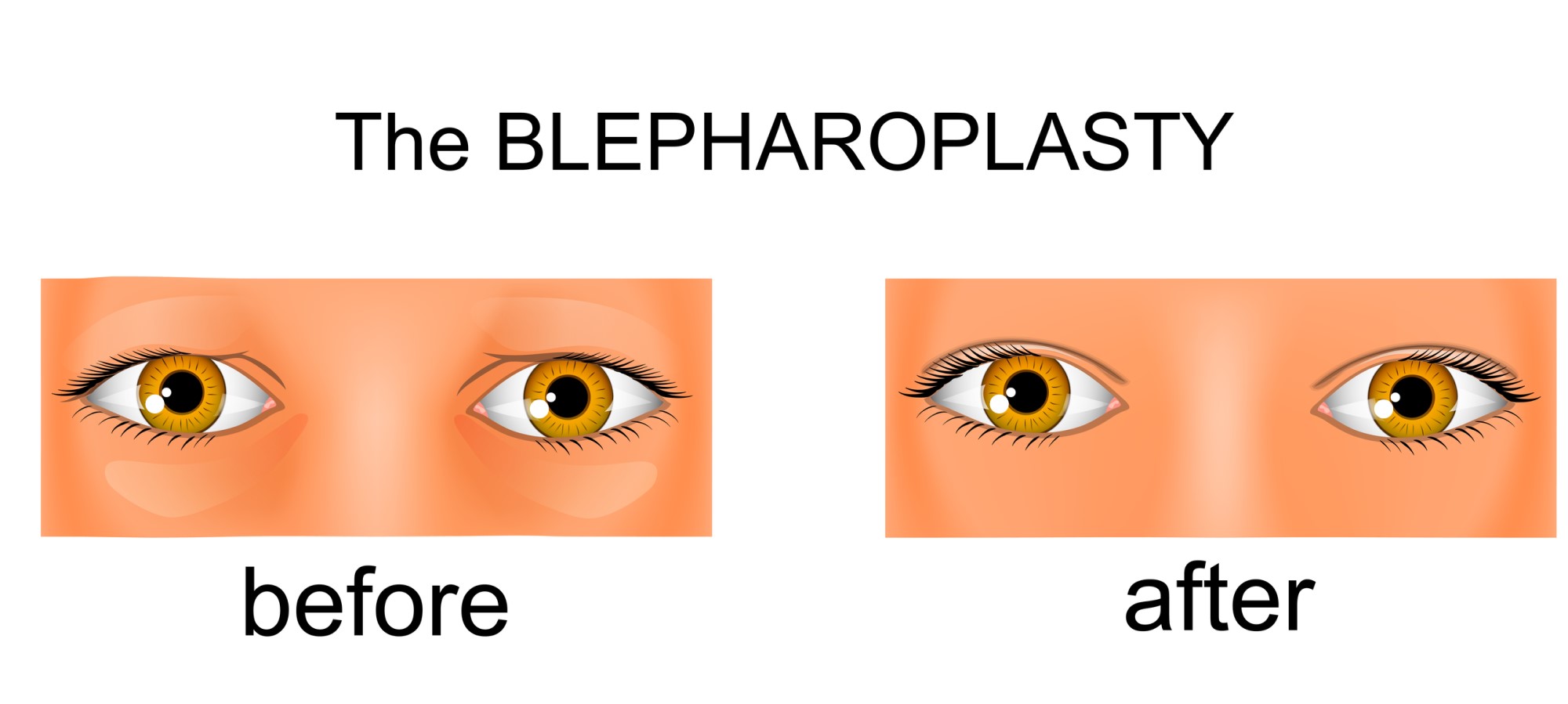 Какая блефаропластика лучше: лазерная или хирургическая?