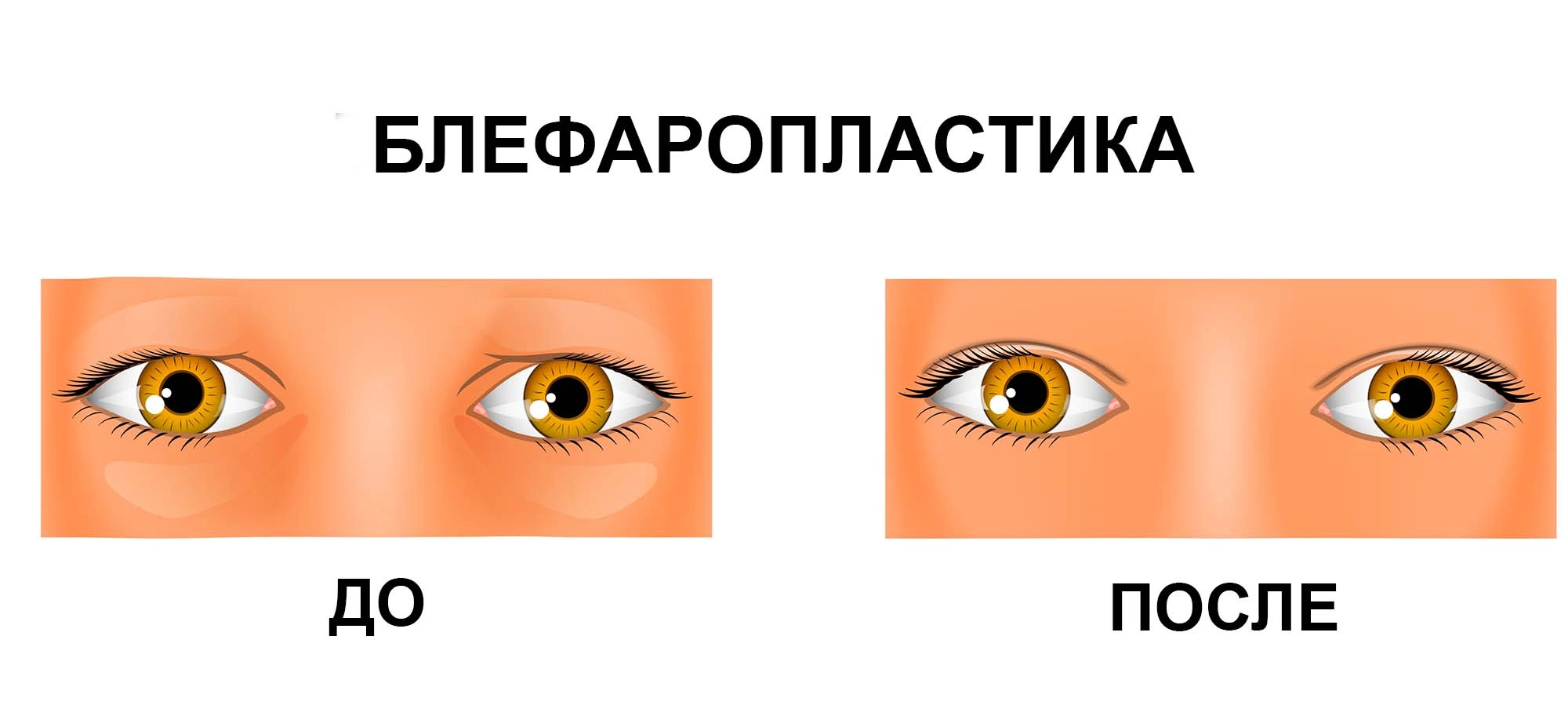 Блефаропластика: что это такое, как делается, противопоказания, зачем она  нужна, показания, как проходит