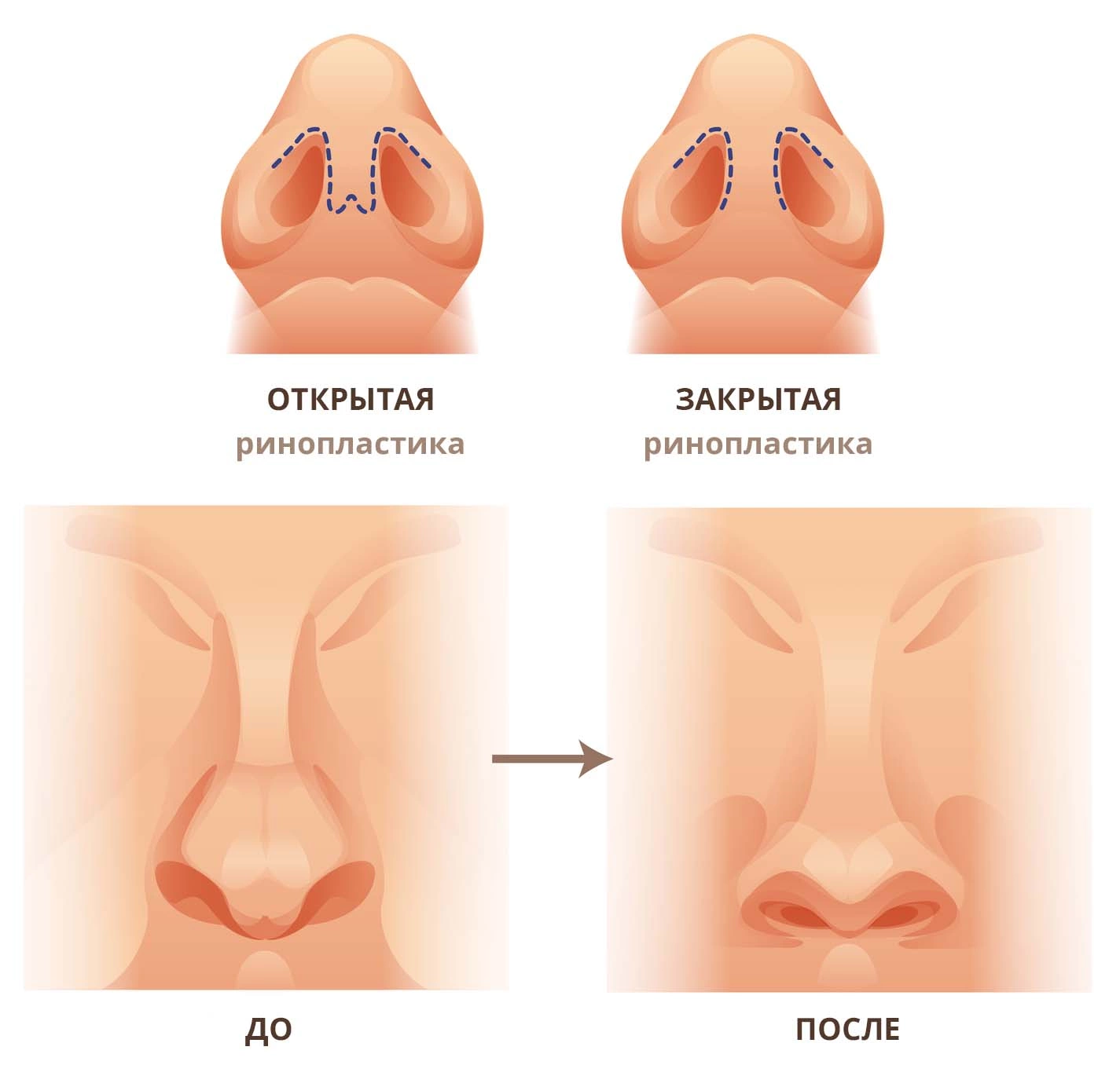 Ринопластика: что такое, виды, сколько длится, как делают операцию на нос