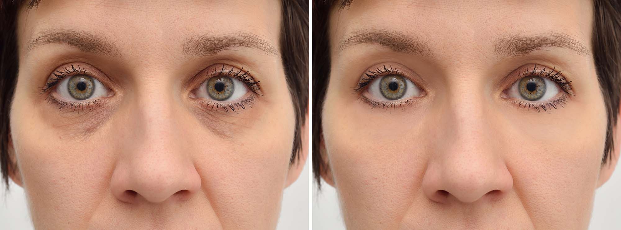 Эффект круглого глаза после блефаропластики