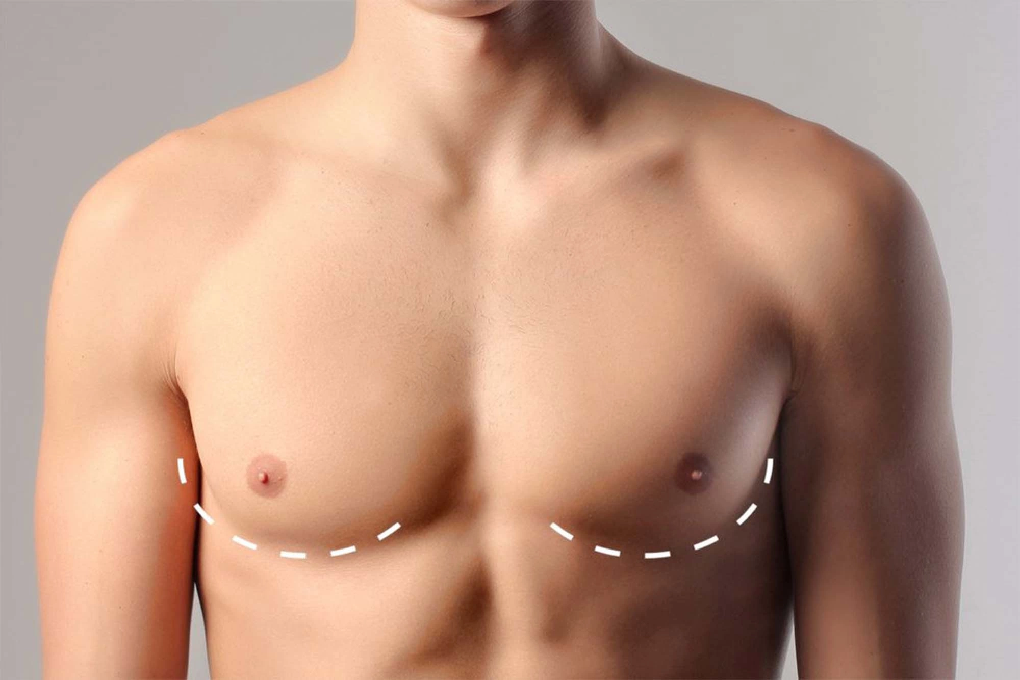 Липосакция груди у мужчин