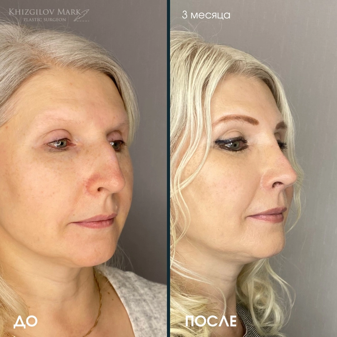 Ринопластика - фото до