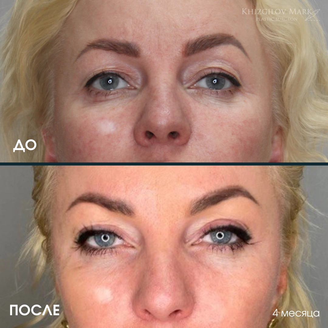 Блефаролластика - фото до