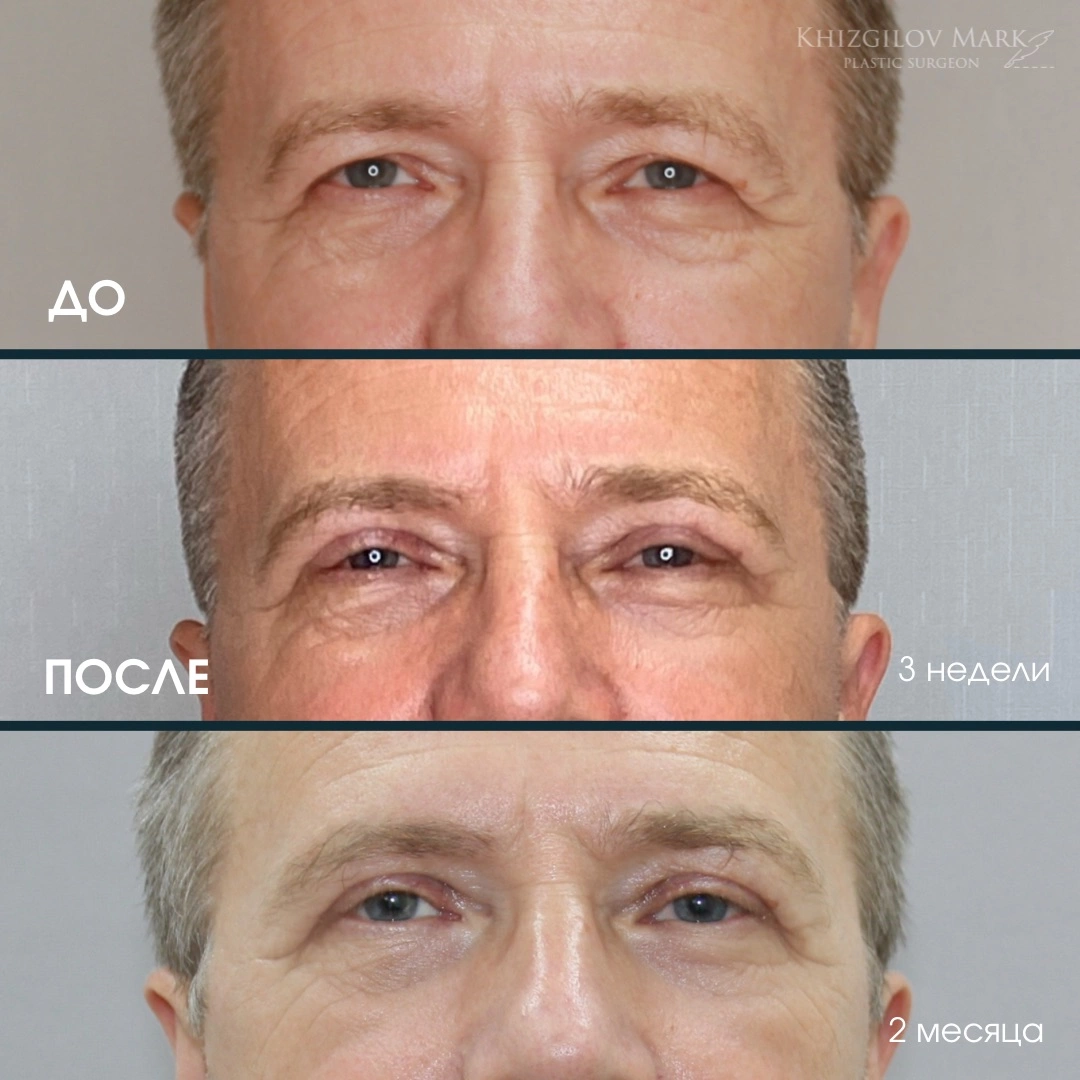 Блефаропластика - фото до