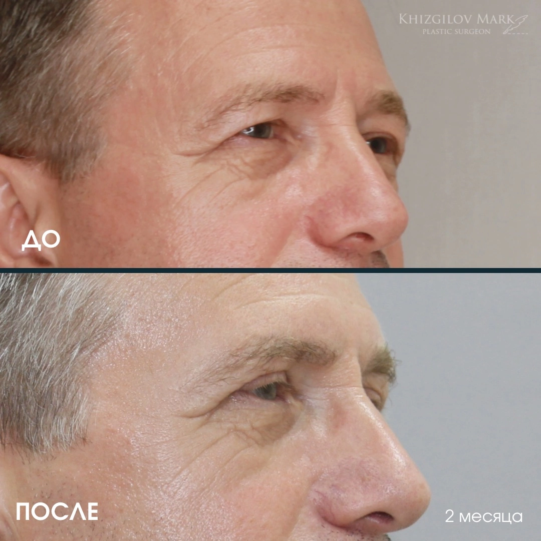 Блефаропластика - фото до