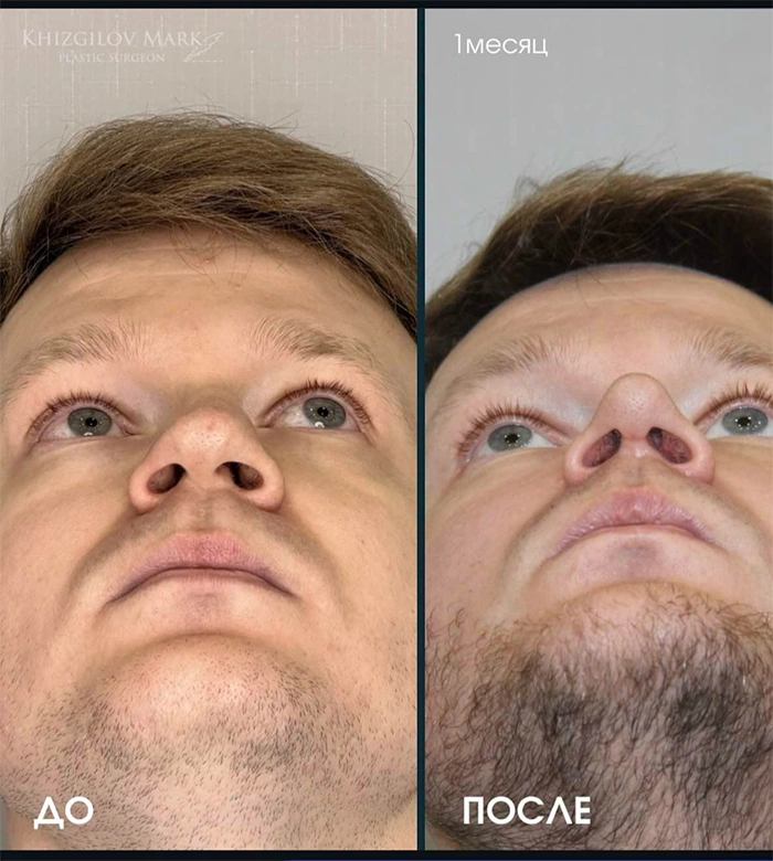 Пластика носа - фото до