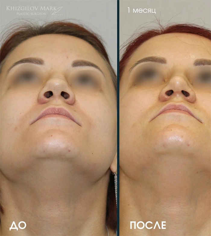 Пластика носа - фото до