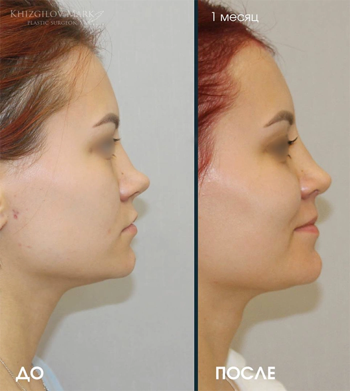 Пластика носа - фото до
