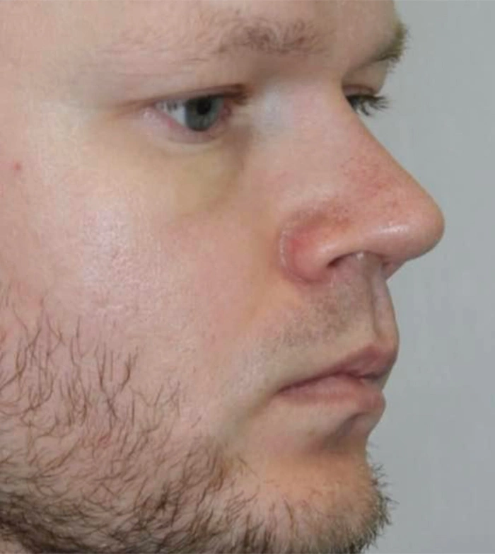 Пластика носа - фото до