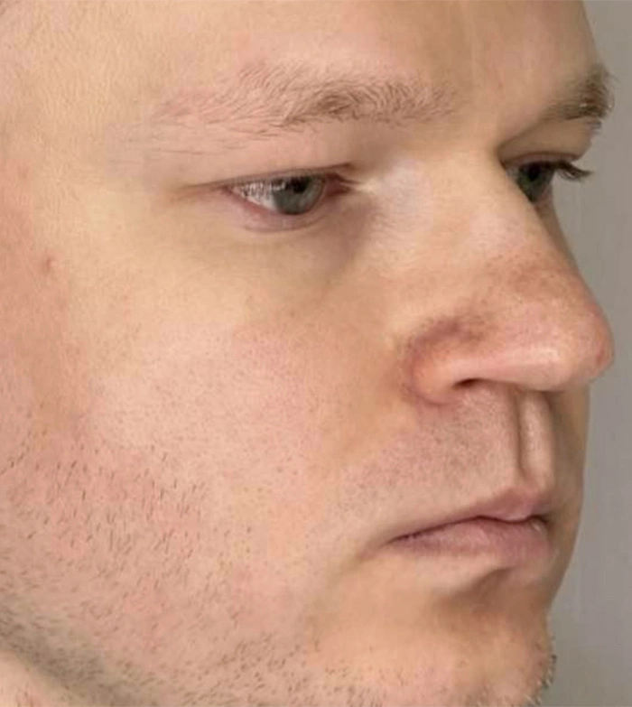 Пластика носа - фото до