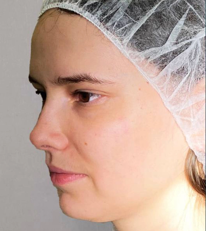 Пластика носа - фото до