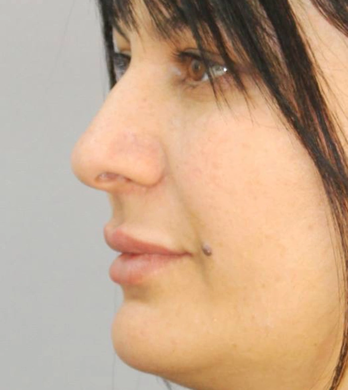Пластика носа - фото до