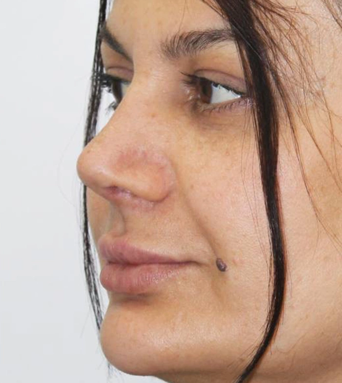 Пластика носа - фото до