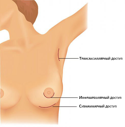 Виды доступов в маммопластике