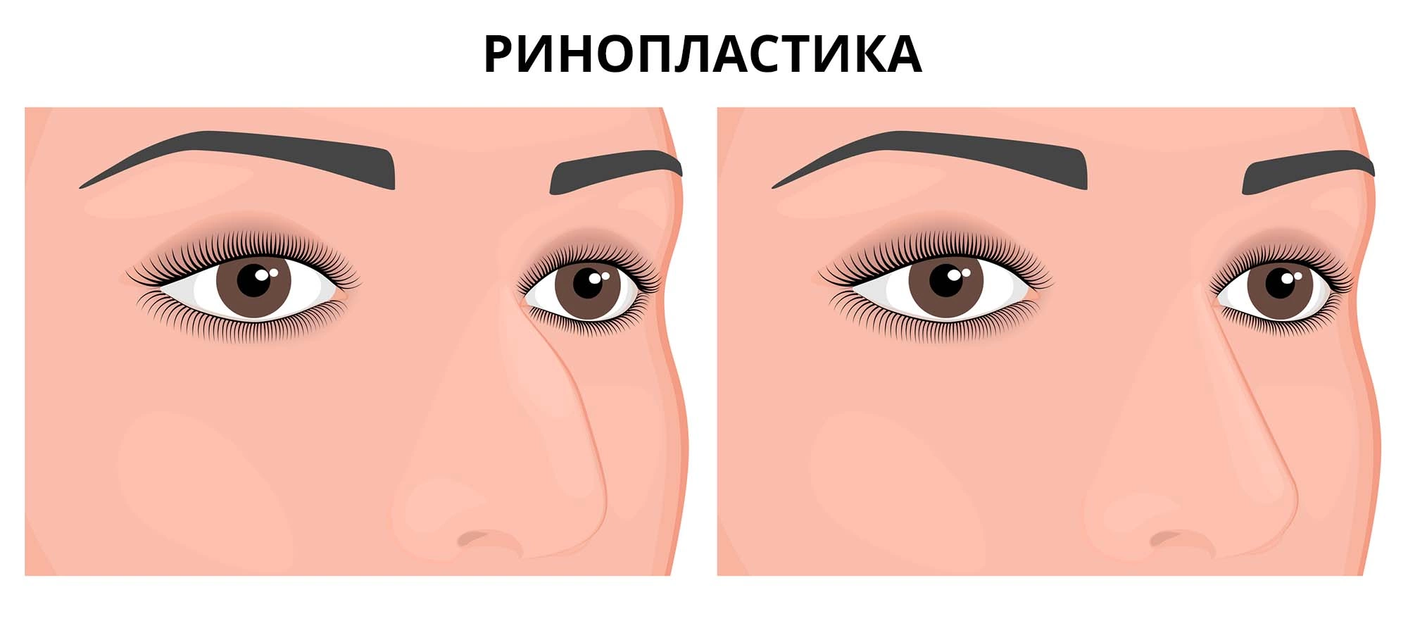 Ринопластика: что такое, виды, сколько длится, как делают операцию на нос