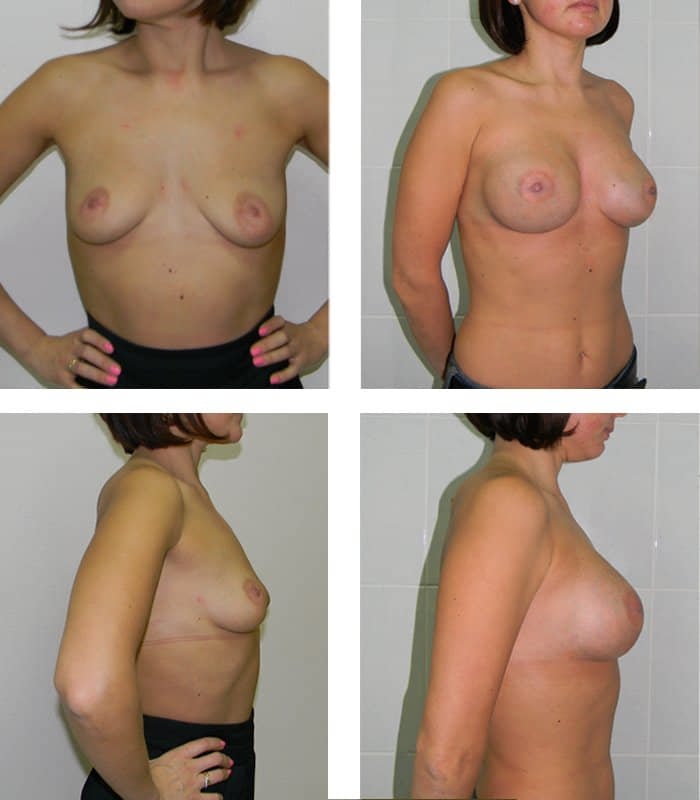 Исправление асимметрии груди