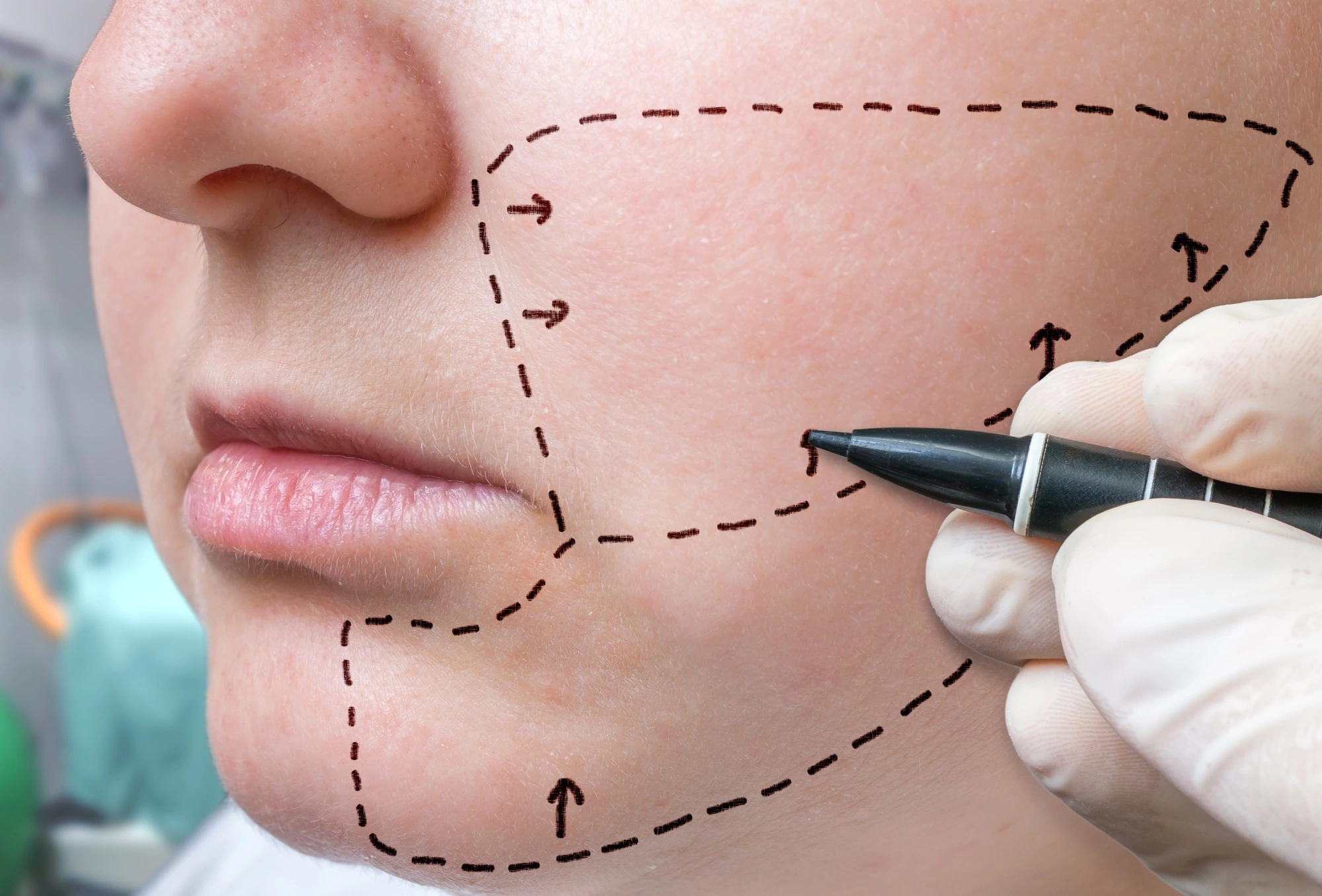 Большие щеки: как убрать, причины, что делать в домашних условиях, у  косметолога или пластического хирурга
