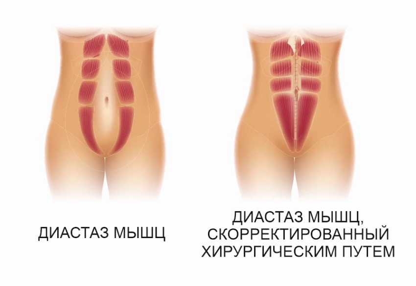 Операция по удалению диастаза
