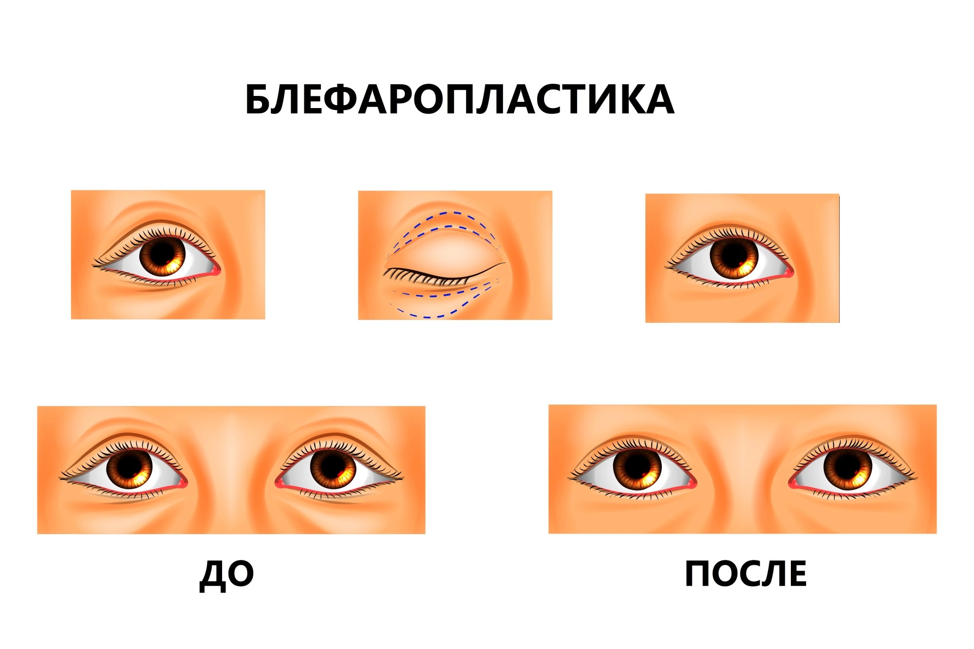 Повторная блефаропластика