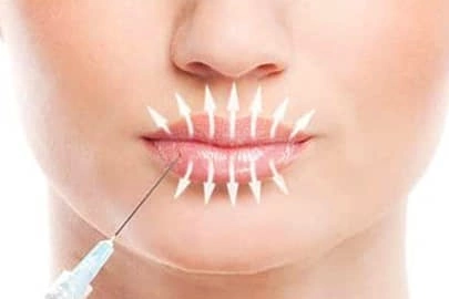 Коррекция губ нитями