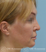 Лигатурная подтяжка лица что это. Смотреть фото Лигатурная подтяжка лица что это. Смотреть картинку Лигатурная подтяжка лица что это. Картинка про Лигатурная подтяжка лица что это. Фото Лигатурная подтяжка лица что это