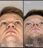 До-После