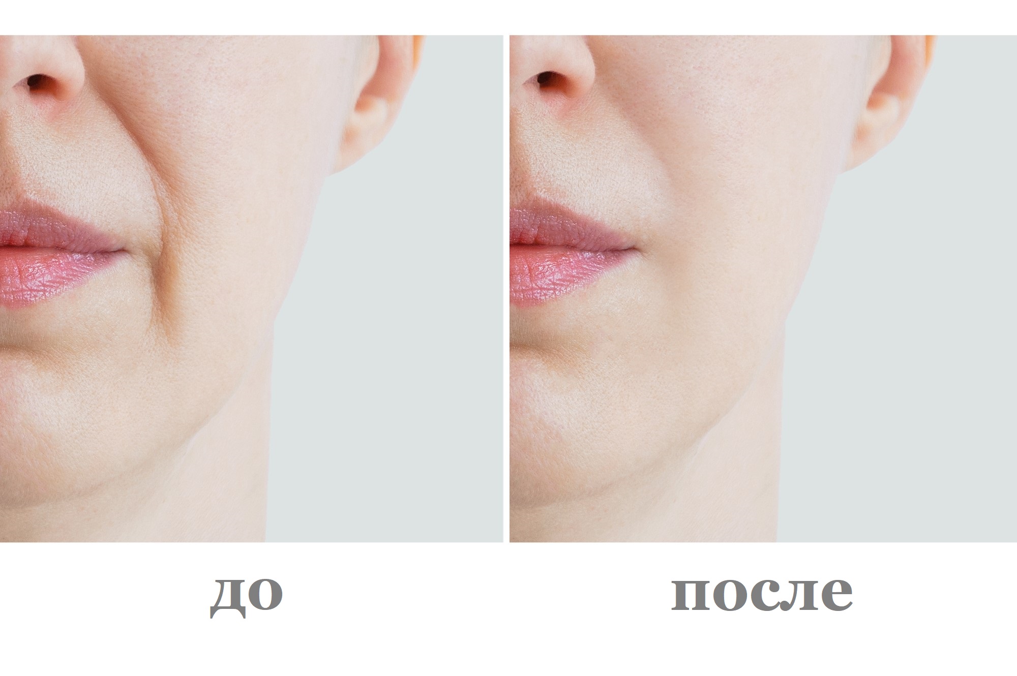 Коррекция носогубных складок на лице