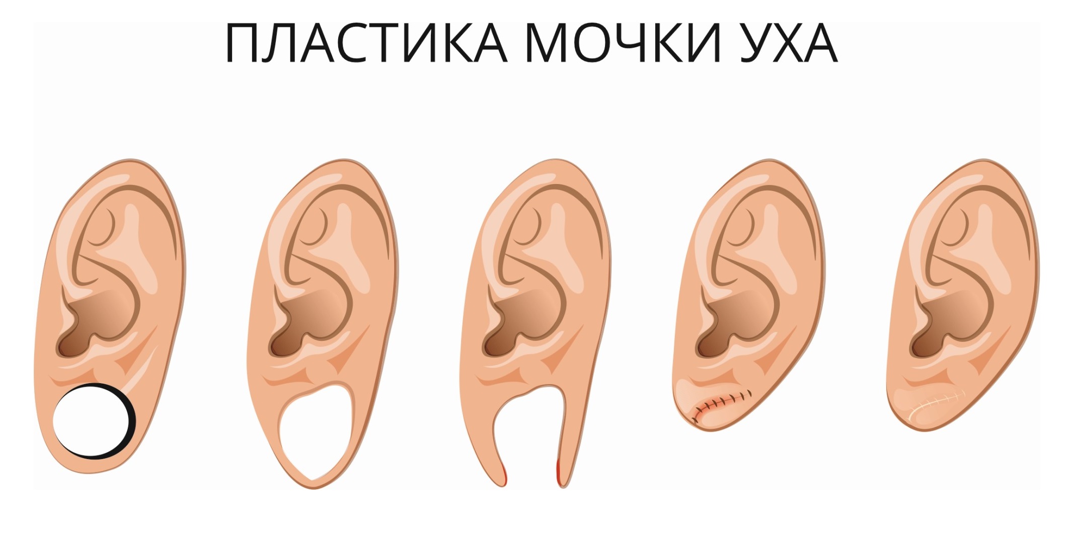 Пластика мочки уха