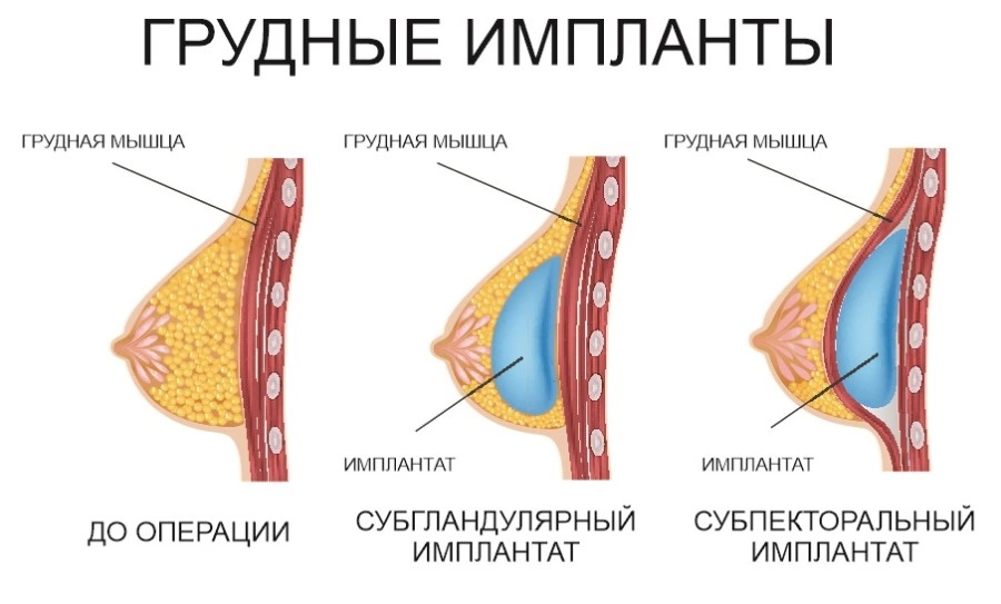 Что такое маммопластика?