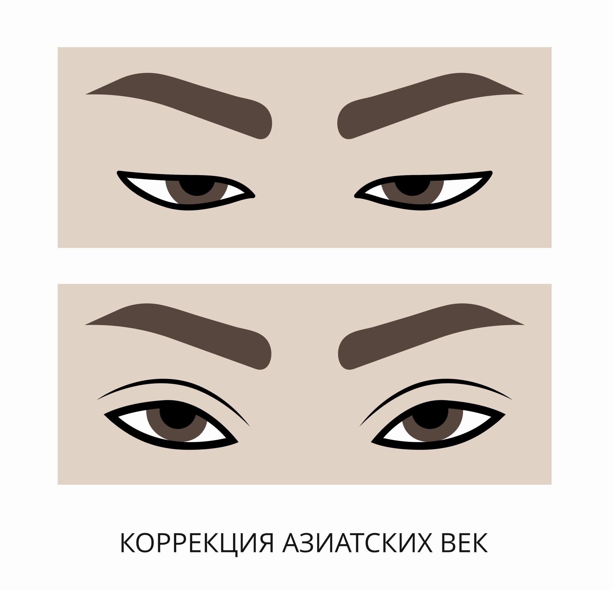 Блефаропластика азиатских глаз
