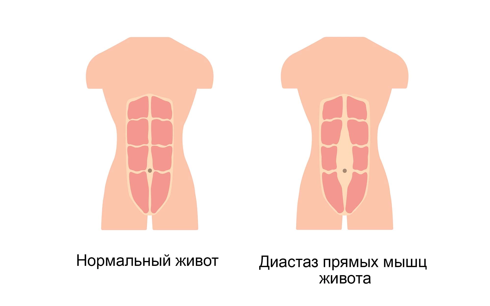 Как убрать диастаз живота