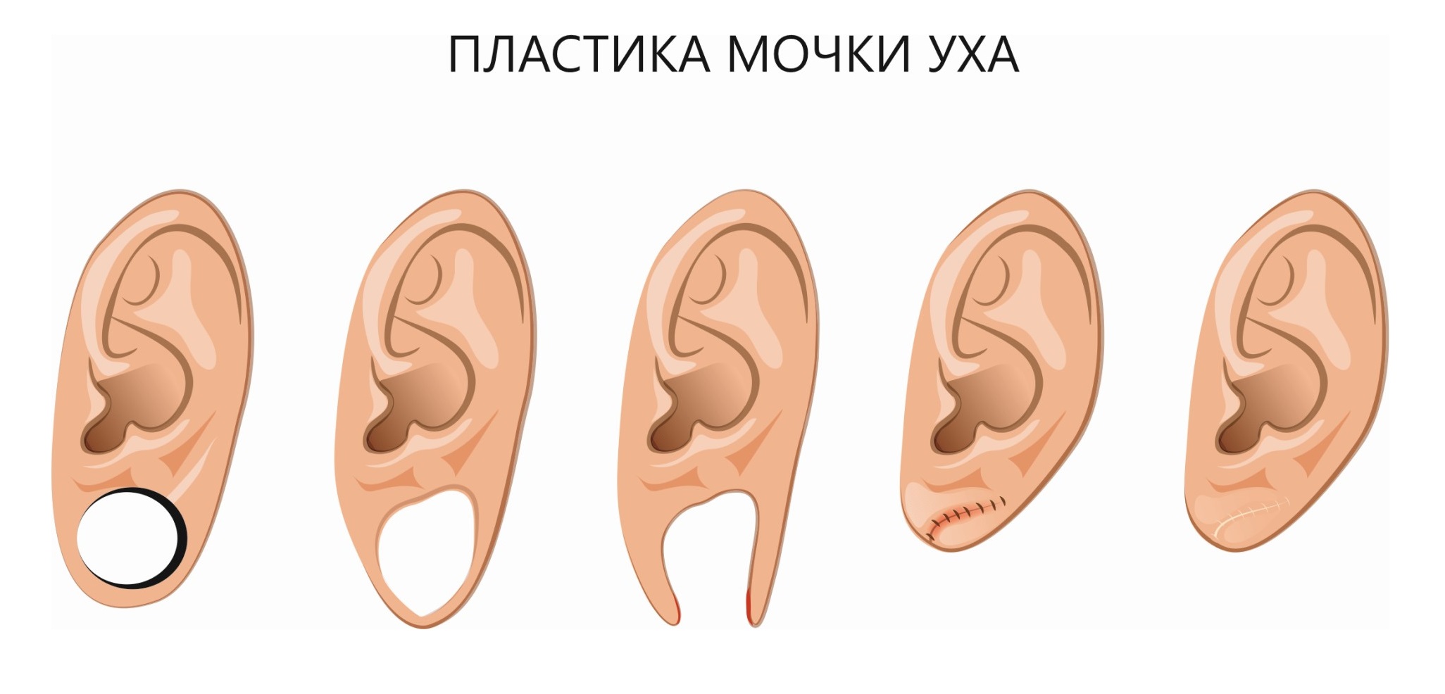 Как восстановить уши после тоннелей