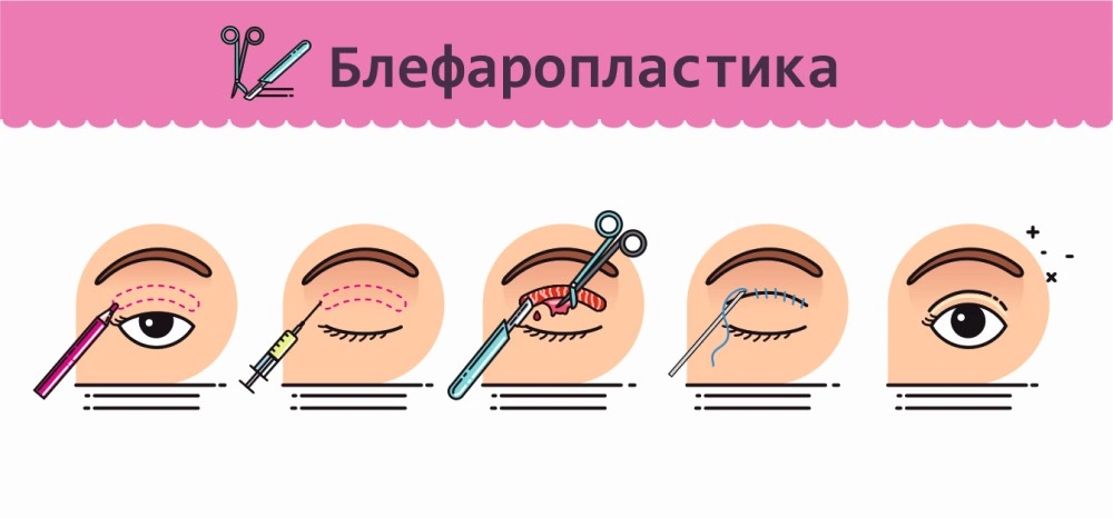 Повторная блефаропластика