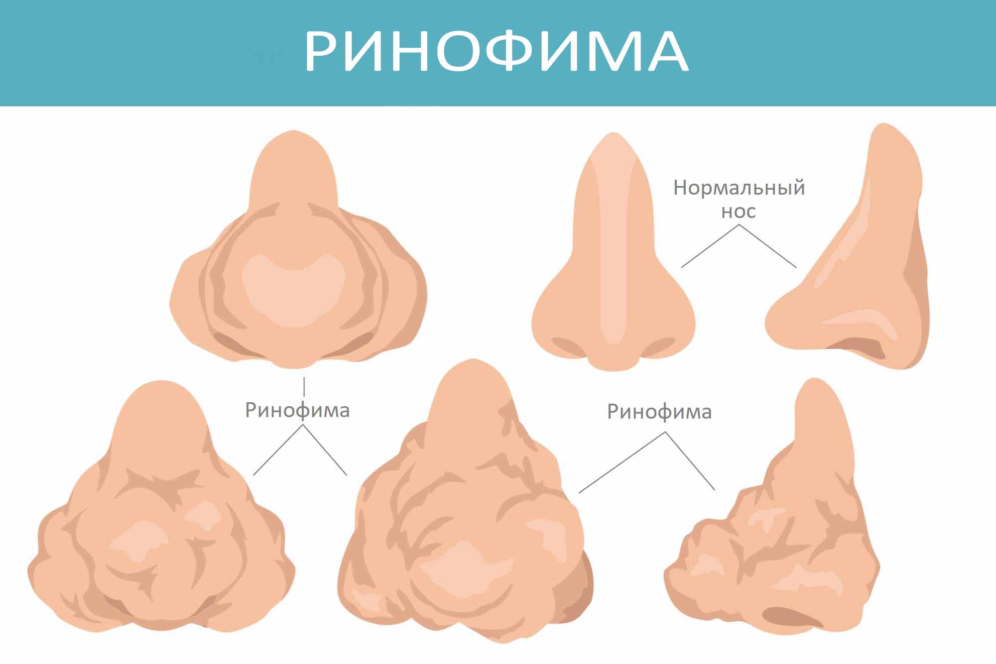 Ринофима
