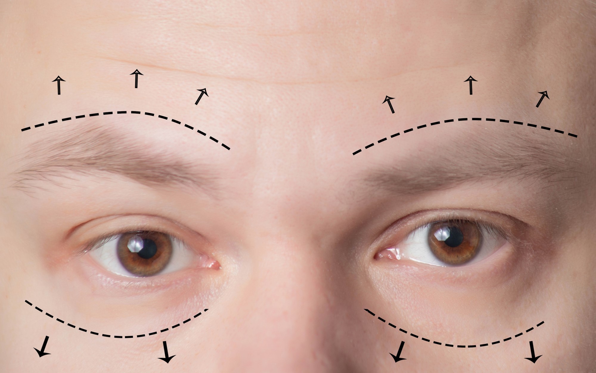 Разные глаза после блефаропластики