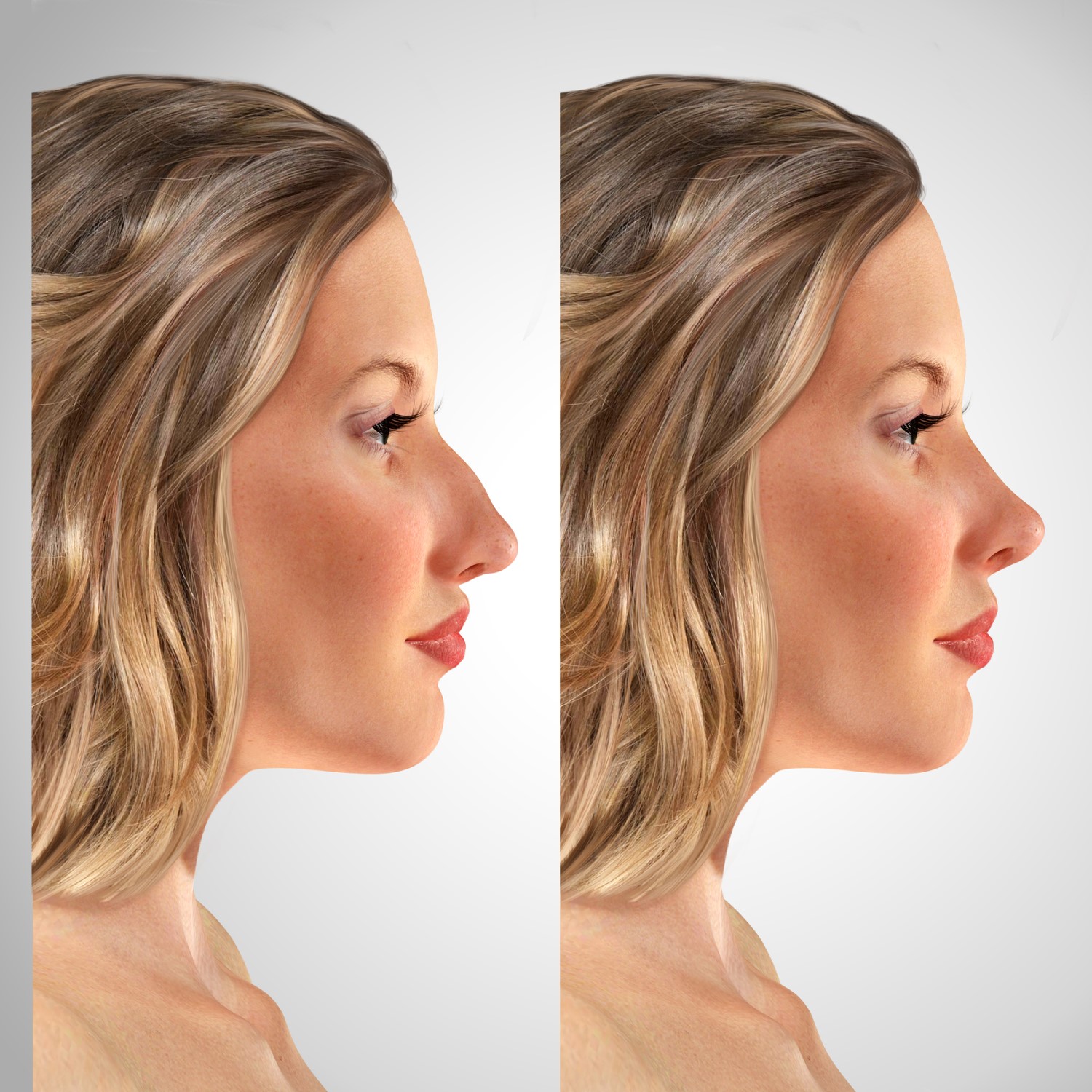 Моделирование носа перед ринопластикой