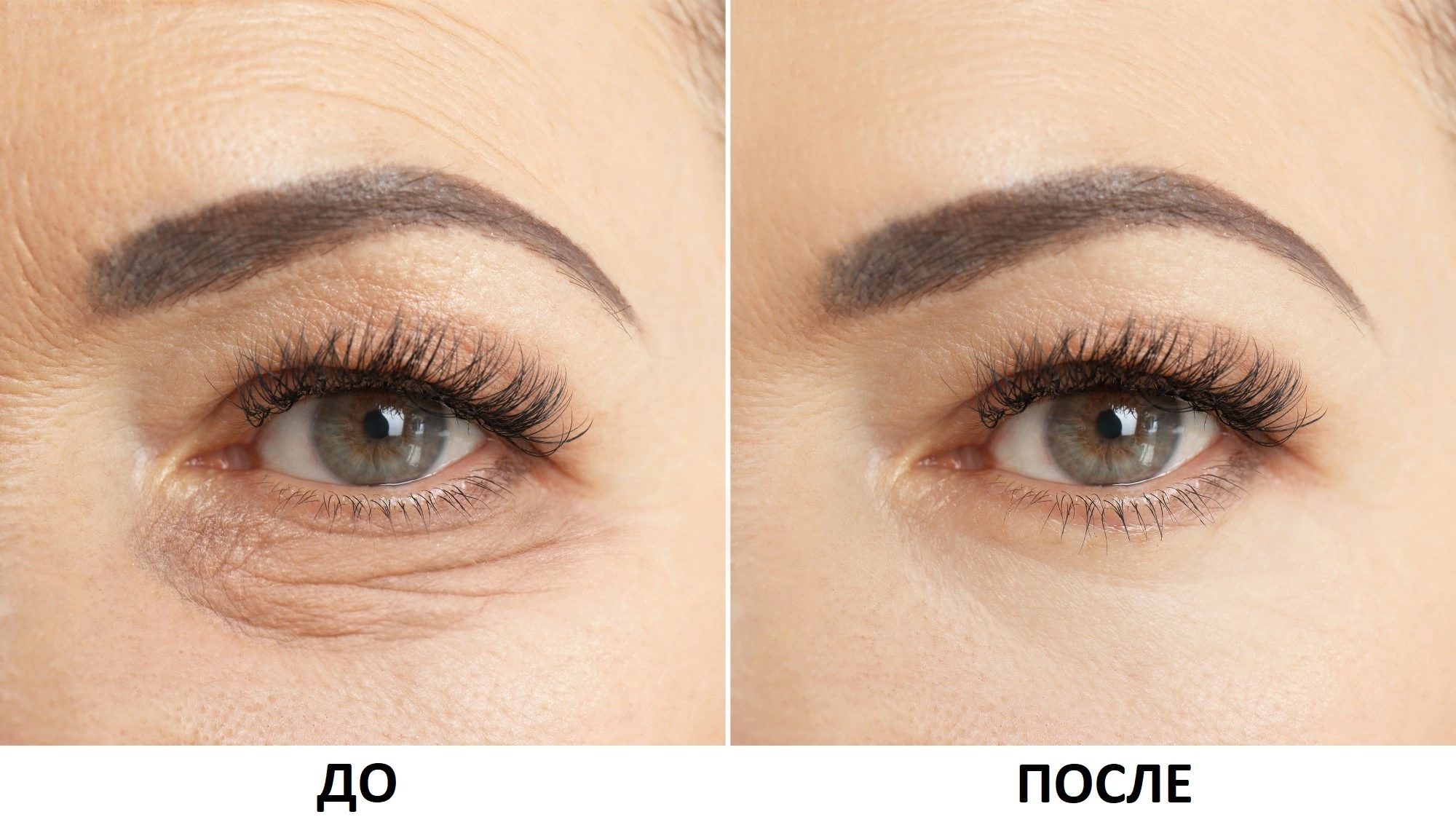 Трансконъюнктивальная блефаропластика