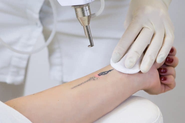 Методы удаления татуировок