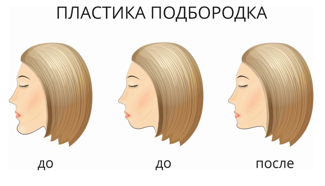 Увеличение подбородка